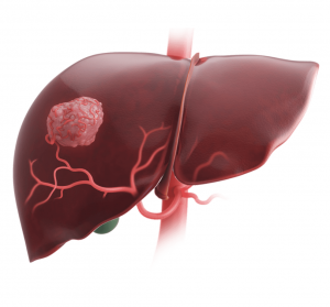 Image of a liver with a large tumor